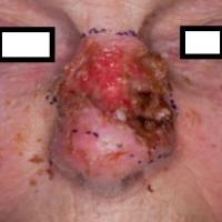 
	Skin cancer treated with external beam…