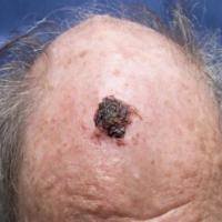 
	Skin cancer treated with&nbsp;brachytherapy:…