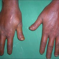 
	Systemic sclerosis&nbsp;

	Shortening of the…