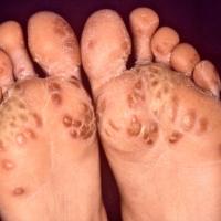 
	Reactive arthritis - psoriasiform hyperkeratosis
