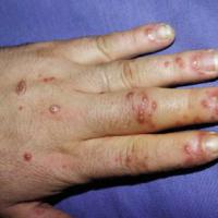 
	Reactive arthritis -&nbsp;palmoplantar…
