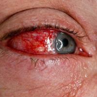 
	Reactive arthritis - uveitis&nbsp;