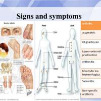 
	Reactive arthritis