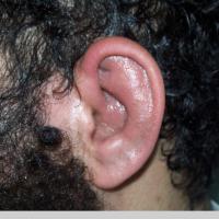 
	Relapsing polychondritis

	Earlobe spared