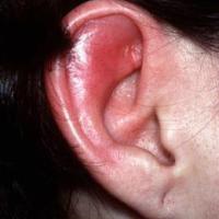 
	Relapsing polychondritis

	Earlobe spared