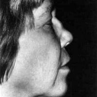 
	Relapsing polychondritis

	Saddle‐nose…