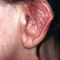 
	Relapsing polychondritis

	The &lsquo;forward…