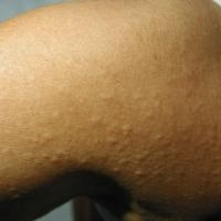 
	RA - interstitial granulomatous dermatitis