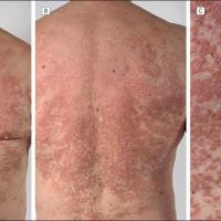 
	RA - interstitial granulomatous dermatitis