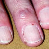 
	RA - nailfold infarcts&nbsp;