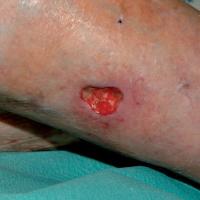 
	RA - leg ulcer