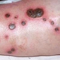 
	RA - small vessel vasculitis and ulceration 