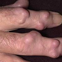 
	Rheumatoid nodules
