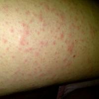 
	Still's disease
