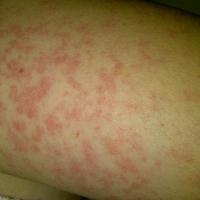 
	Still's disease