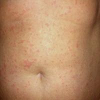 
	Still's disease