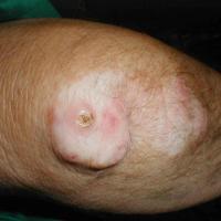 
	Rheumatoid nodules