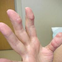 
	Rheumatoid nodules