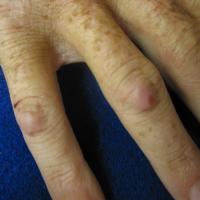 
	Rheumatoid nodules