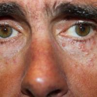 
	Granulomatous rosacea

	Image property of…