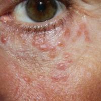 
	Same patient as previous image

	Image…