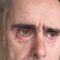 
	Granulomatous rosacea in a more acutely…