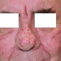
	Rhinophyma