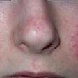 
	Rosacea exacerbated by topical steroids