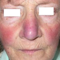 
	Rosacea

	Erythema and telangiectases of the…
