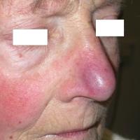 
	Same patient as figure 12