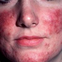
	Rosacea
	
	Very marked erythema with papules…
