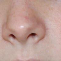 
	Early rosacea in a relatively young patient 