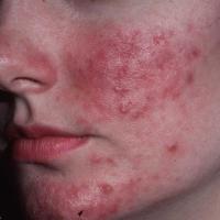 
	Rosacea 