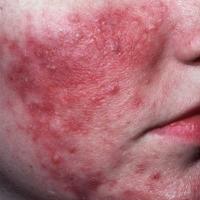 
	Rosacea: close-up