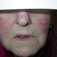 
	Vascular rosacea