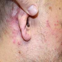 
	Rosacea: post-auricular