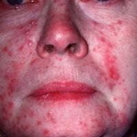
	Rosacea