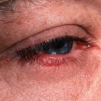 
	Ocular rosacea with involvement of lower eyelid