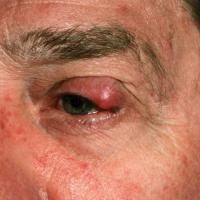 
	Rosacea with chalazion