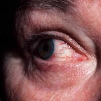 
	Ocular rosacea with marked conjunctival…