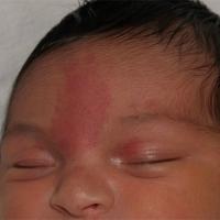 
	A salmon patch on the glabella (angel's…