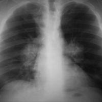 
	Hilar lymphadenopathy