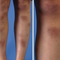 
	Erythema nodosum