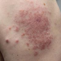 
	Sarcoid - papules and plaque
