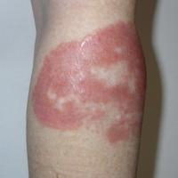 
	Plaque sarcoid

	Same patient as previous…