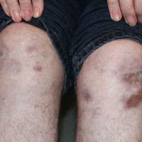 
	Sarcoid - older lesions