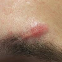 
	Sarcoid - in a scar

	Same patient as…