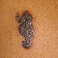 
	Sarcoid in a tattoo
