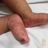 Scabies 
Copied with kind permission from Skin…
