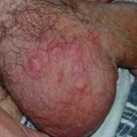 
	Scabetic papules and nodules

	​Copied…